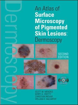 An Atlas of Surface Microscopy of Pigmented Skin Lesions: Dermoscopy, 